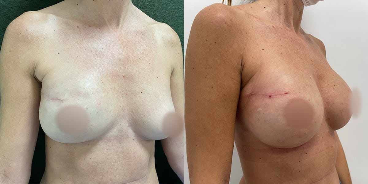 Breast Reconstruction Before & After Gallery - Patient 55793697 - Image 2