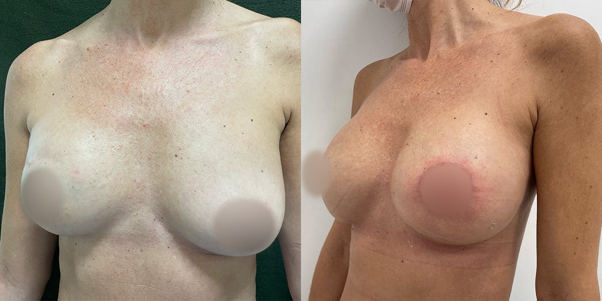 Breast Reconstruction Before & After Gallery - Patient 55793697 - Image 3