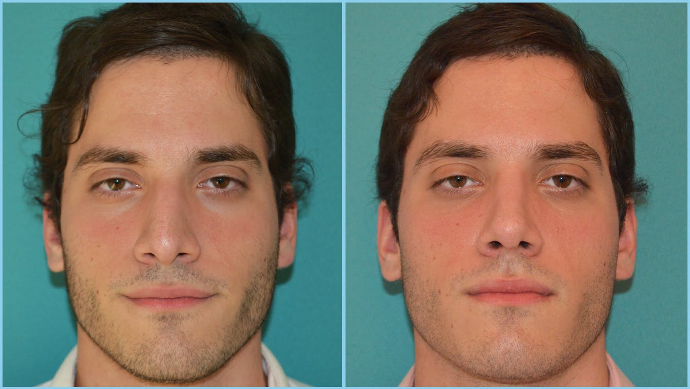 Rhinoplasty Before & After Gallery - Patient 55959445 - Image 2