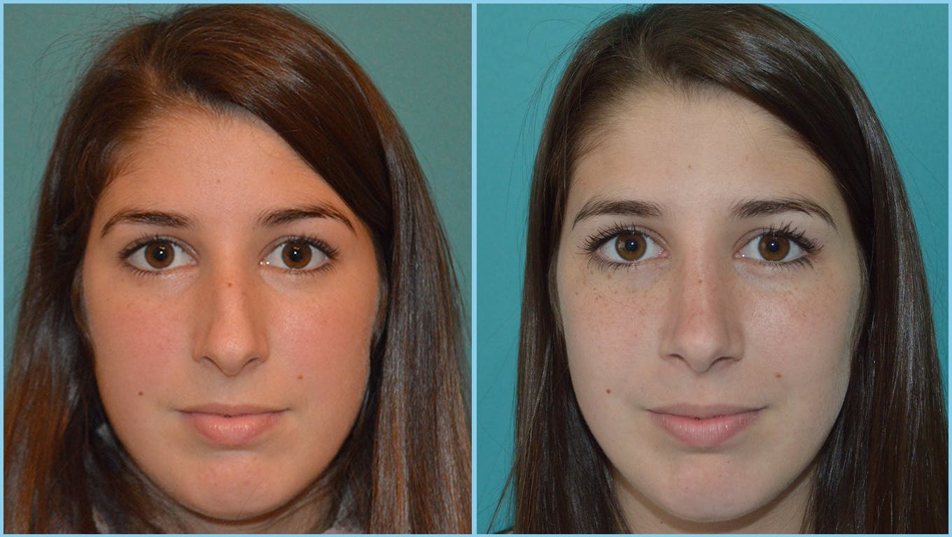Rhinoplasty Before & After Gallery - Patient 55959446 - Image 2
