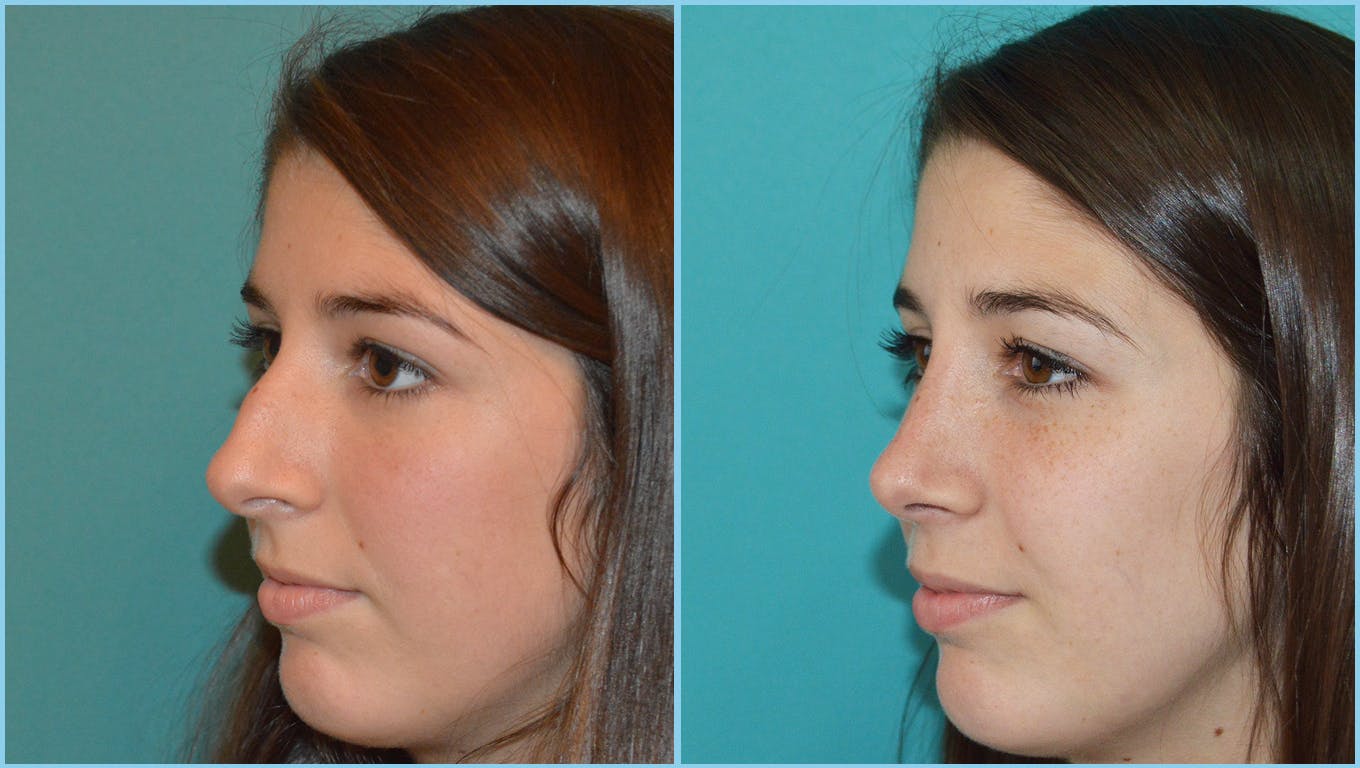 Rhinoplasty Before & After Gallery - Patient 55959446 - Image 3