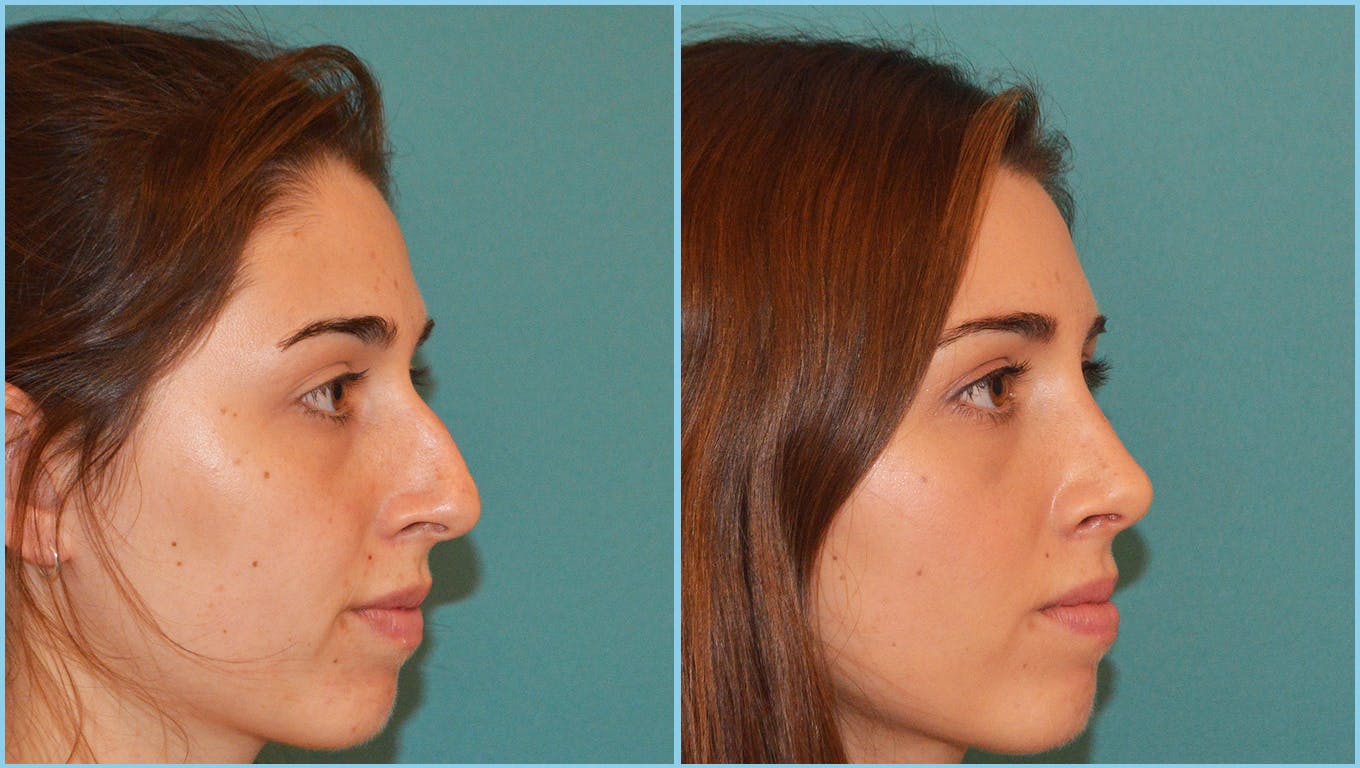 Rhinoplasty Before & After Gallery - Patient 55959447 - Image 3