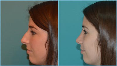 Rhinoplasty Before & After Gallery - Patient 55959446 - Image 1
