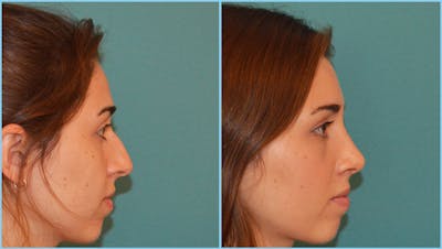 Rhinoplasty Before & After Gallery - Patient 55959447 - Image 1