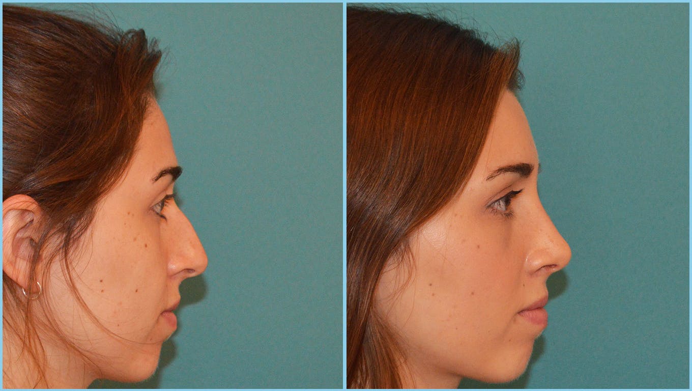 Rhinoplasty Before & After Gallery - Patient 55959447 - Image 1