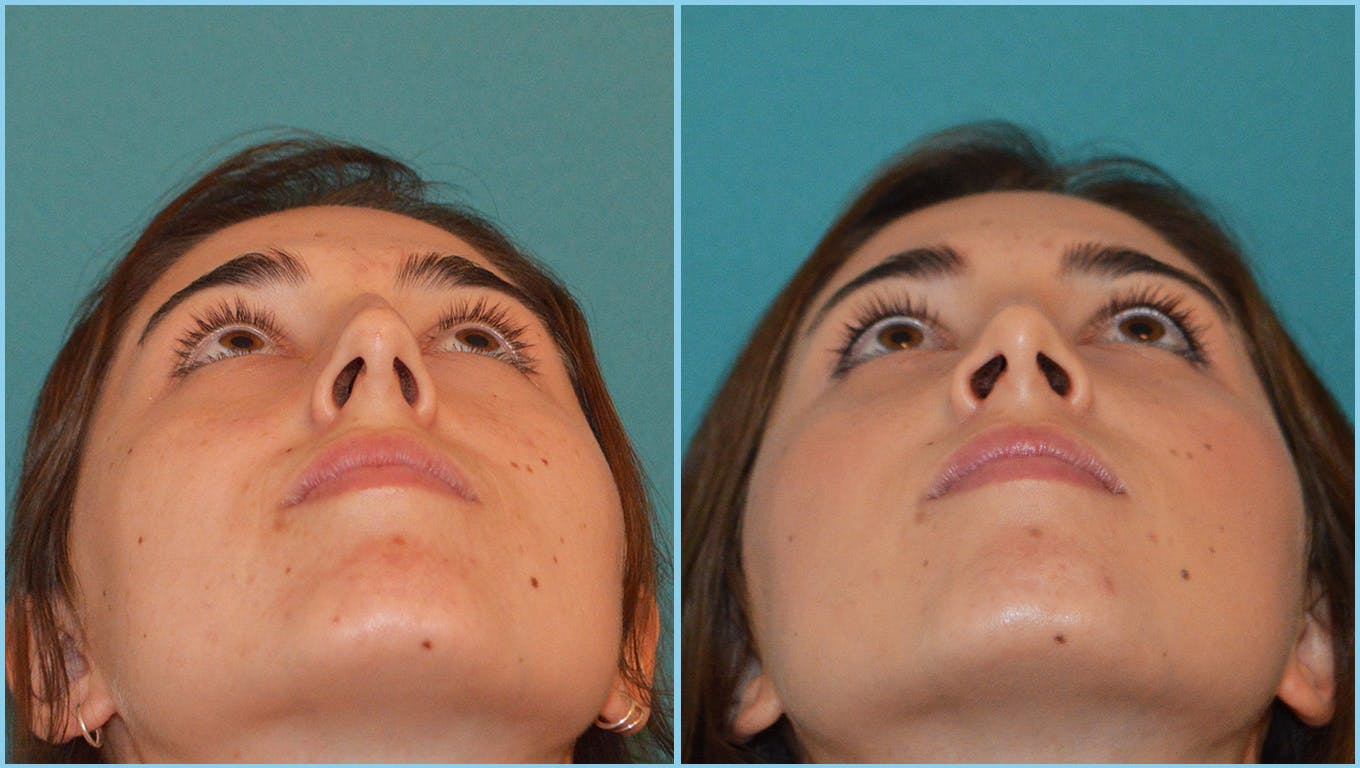 Rhinoplasty Before & After Gallery - Patient 55959447 - Image 4