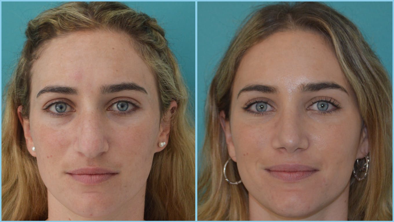 Rhinoplasty Before & After Gallery - Patient 55959449 - Image 2