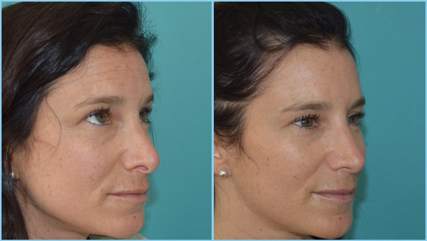 Rhinoplasty Before & After Gallery - Patient 55959450 - Image 2