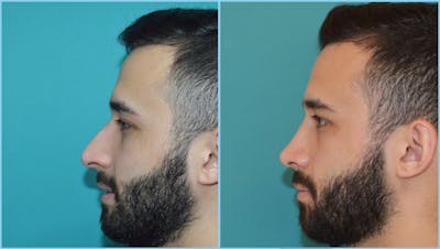 Rhinoplasty Before & After Gallery - Patient 55959448 - Image 1