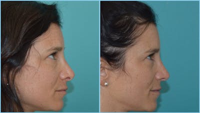 Rhinoplasty Before & After Gallery - Patient 55959450 - Image 1