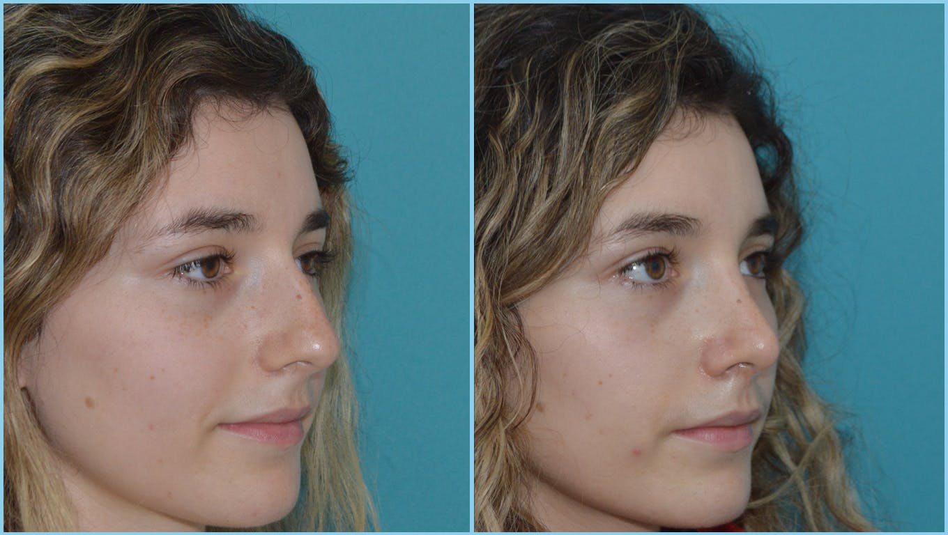 Rhinoplasty Before & After Gallery - Patient 55959451 - Image 2