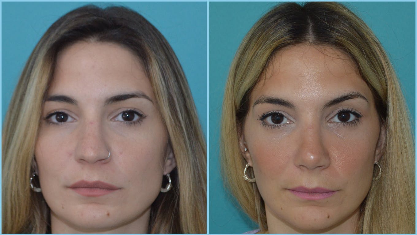 Rhinoplasty Before & After Gallery - Patient 55959452 - Image 2