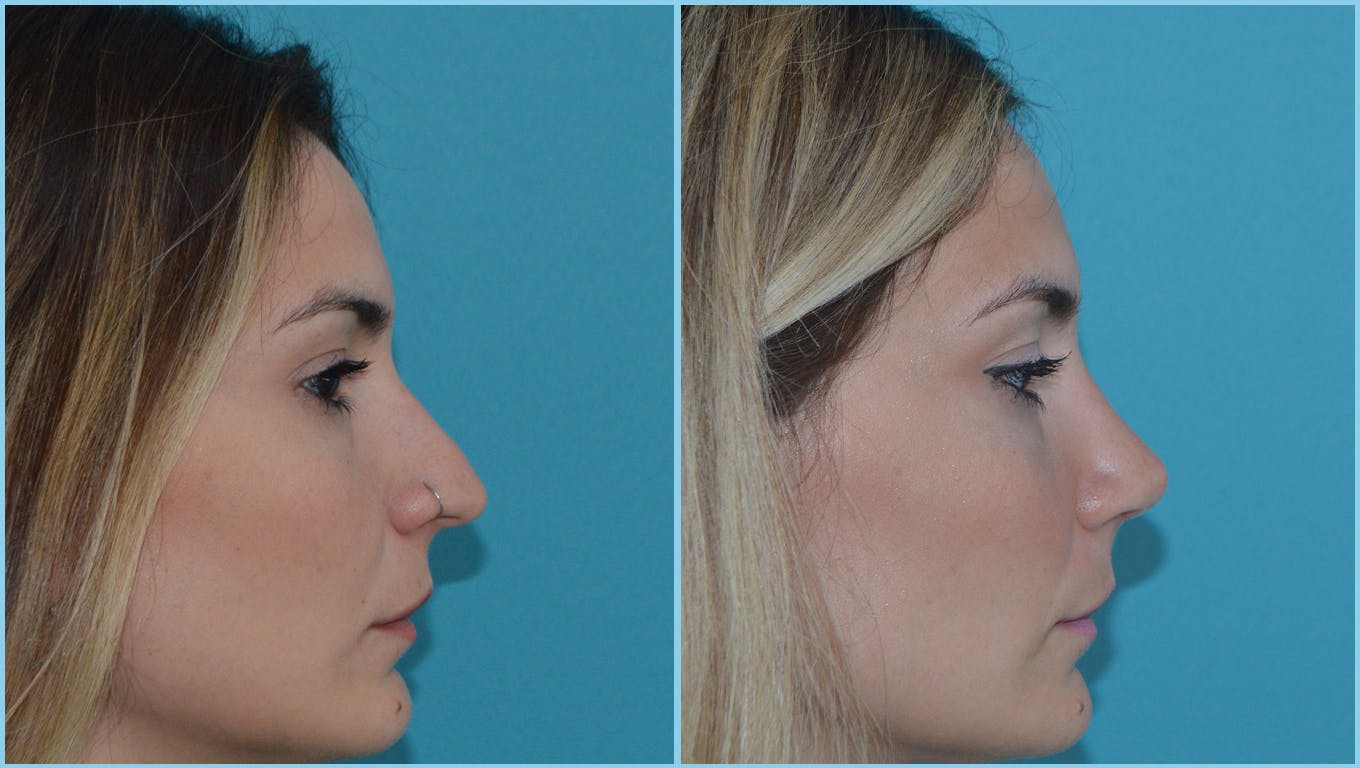 Rhinoplasty Before & After Gallery - Patient 55959452 - Image 1