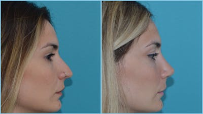Rhinoplasty Before & After Gallery - Patient 55959452 - Image 1