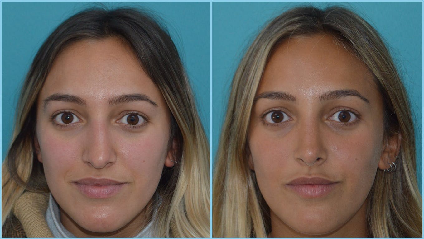 Rhinoplasty Before & After Gallery - Patient 55959454 - Image 2