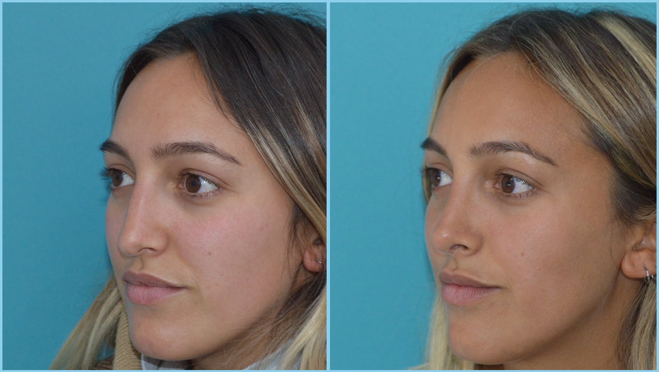 Rhinoplasty Before & After Gallery - Patient 55959454 - Image 3