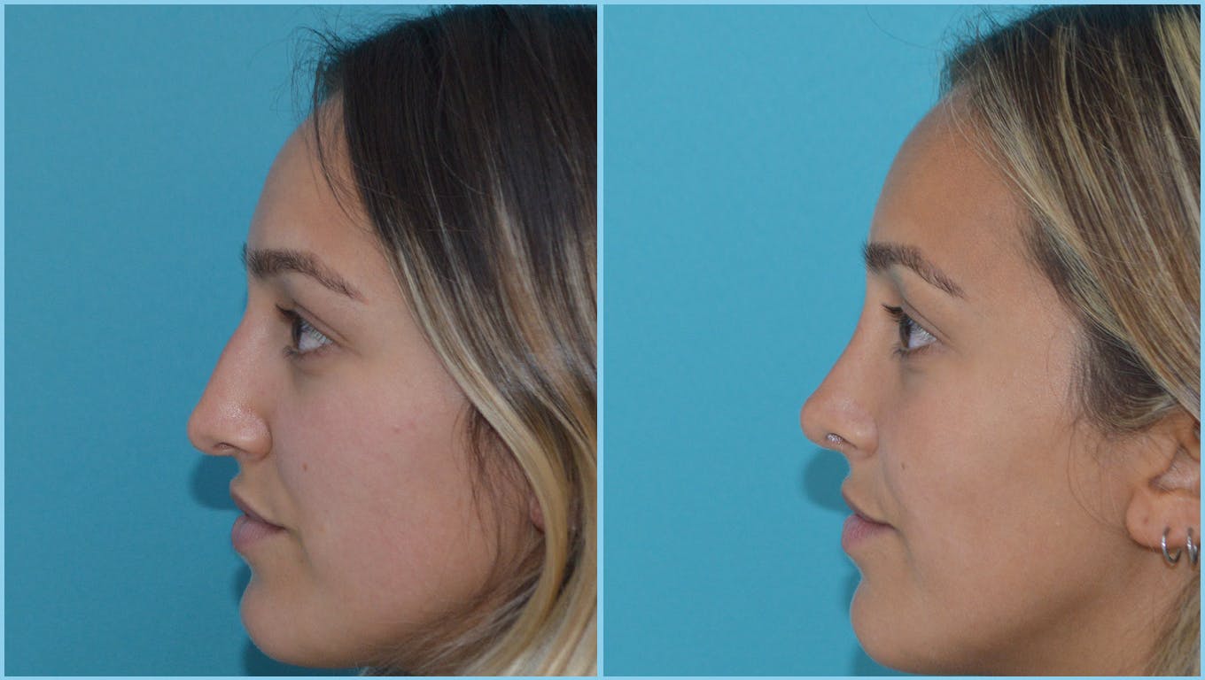 Rhinoplasty Before & After Gallery - Patient 55959454 - Image 1