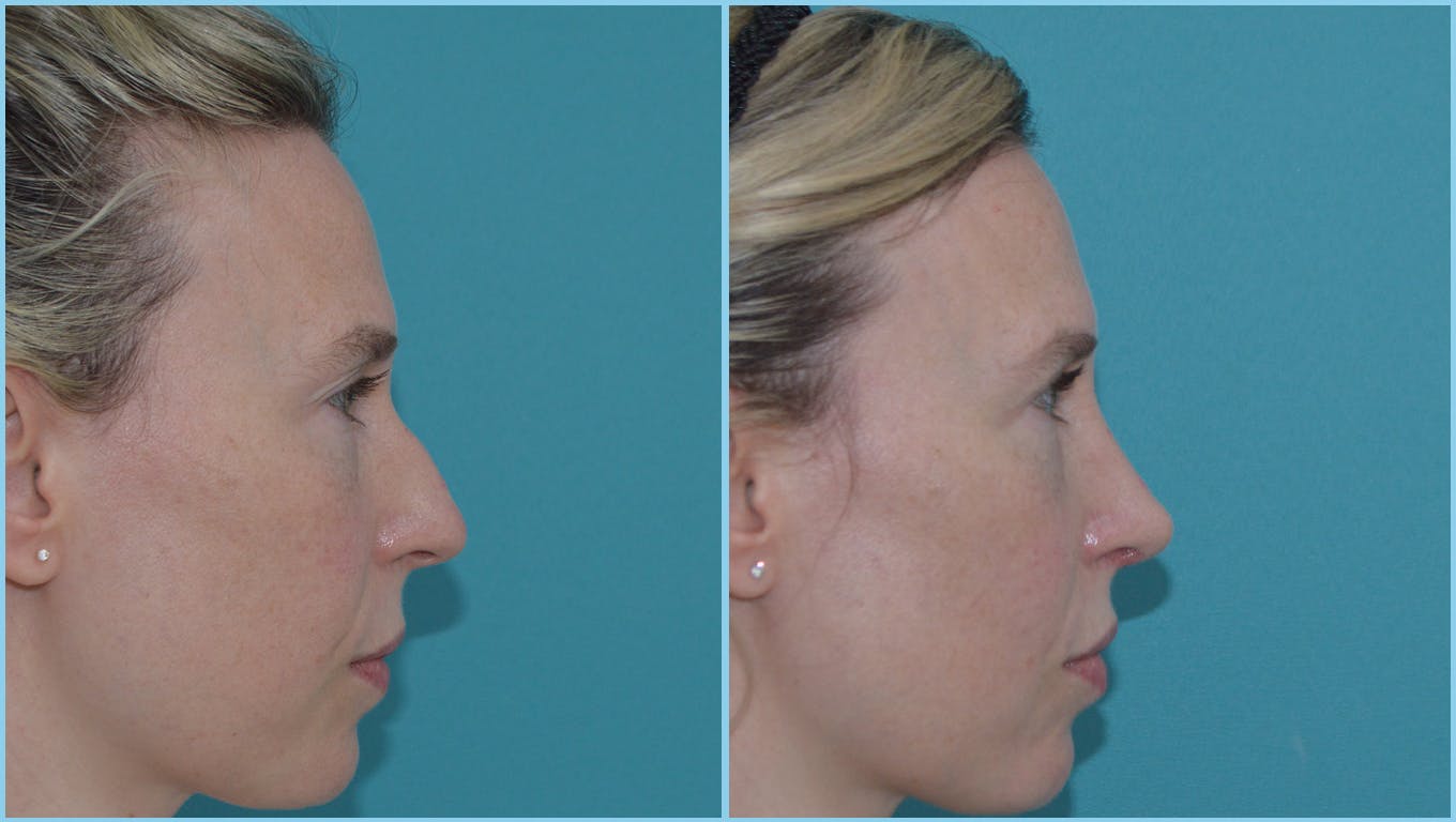 Rhinoplasty Before & After Gallery - Patient 55959455 - Image 1