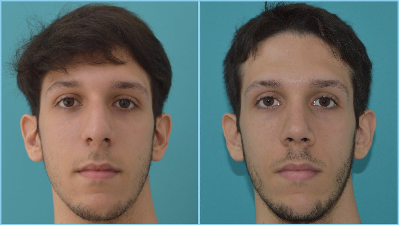 Rhinoplasty Before & After Gallery - Patient 55959456 - Image 2