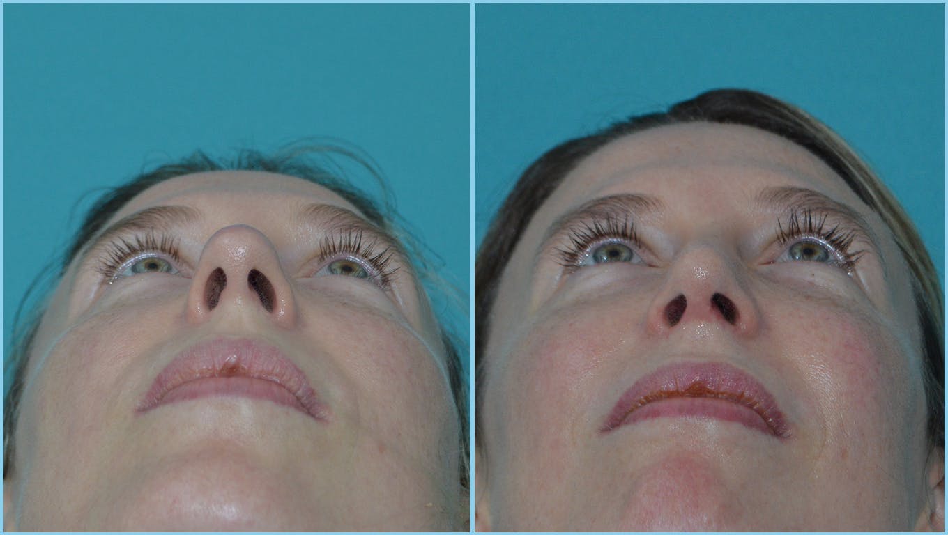 Rhinoplasty Before & After Gallery - Patient 55959455 - Image 3