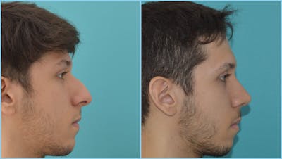 Rhinoplasty Before & After Gallery - Patient 55959456 - Image 1