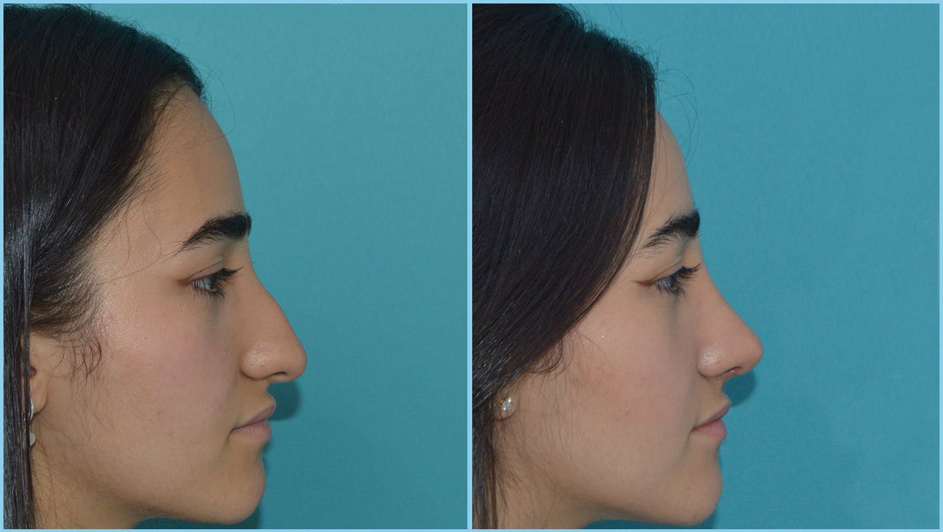 Rhinoplasty Before & After Gallery - Patient 55959457 - Image 1