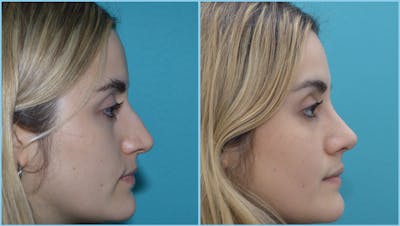 Rhinoplasty Before & After Gallery - Patient 55959458 - Image 1
