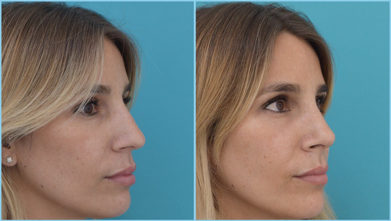 Rhinoplasty Before & After Gallery - Patient 55959459 - Image 3
