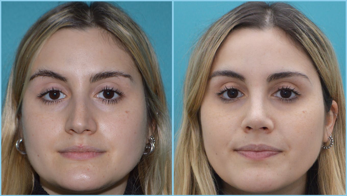 Rhinoplasty Before & After Gallery - Patient 55959458 - Image 4