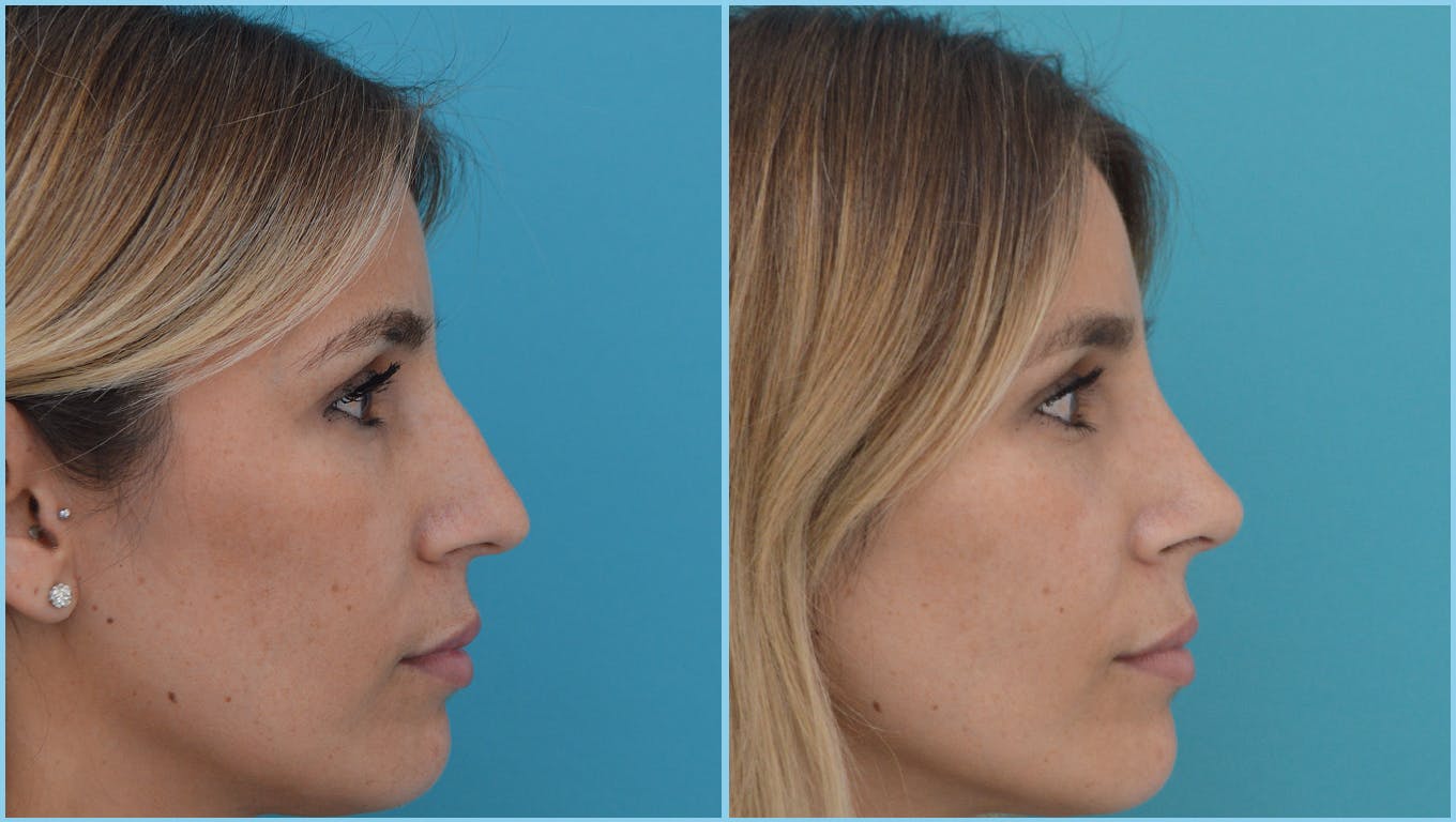 Rhinoplasty Before & After Gallery - Patient 55959459 - Image 1