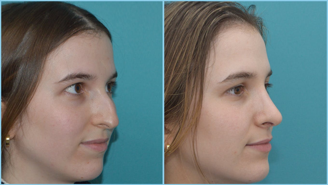 Rhinoplasty Before & After Gallery - Patient 55959460 - Image 3