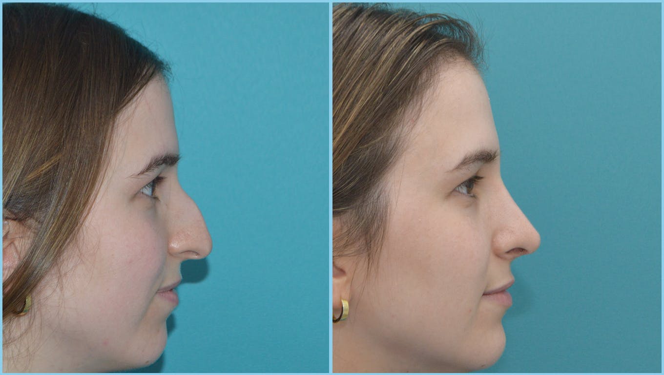 Rhinoplasty Before & After Gallery - Patient 55959460 - Image 1