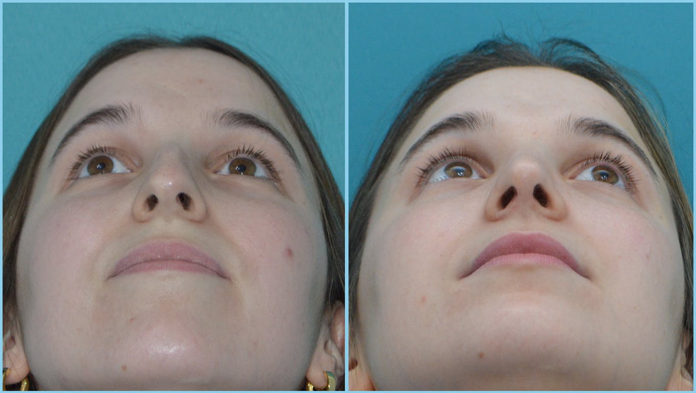 Rhinoplasty Before & After Gallery - Patient 55959460 - Image 4
