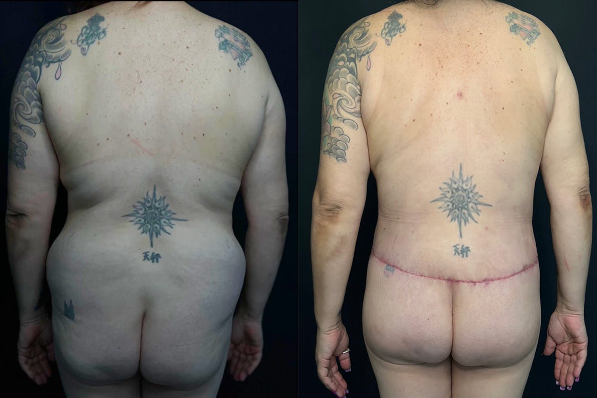 Brazilian Butt Lift Before & After Gallery - Patient 56112189 - Image 1