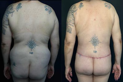 Tummy Tuck Before & After Gallery - Patient 56112183 - Image 1