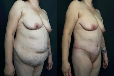 Tummy Tuck Before & After Gallery - Patient 56112200 - Image 1
