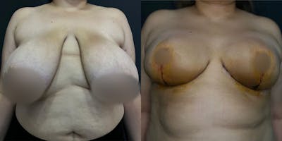 Breast Reduction Before & After Gallery - Patient 56112205 - Image 1