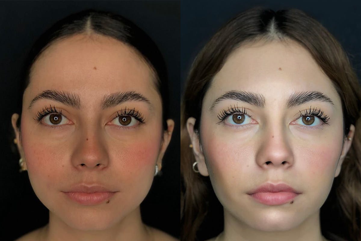 Buccal Fat Removal Before & After Gallery - Patient 56112213 - Image 1