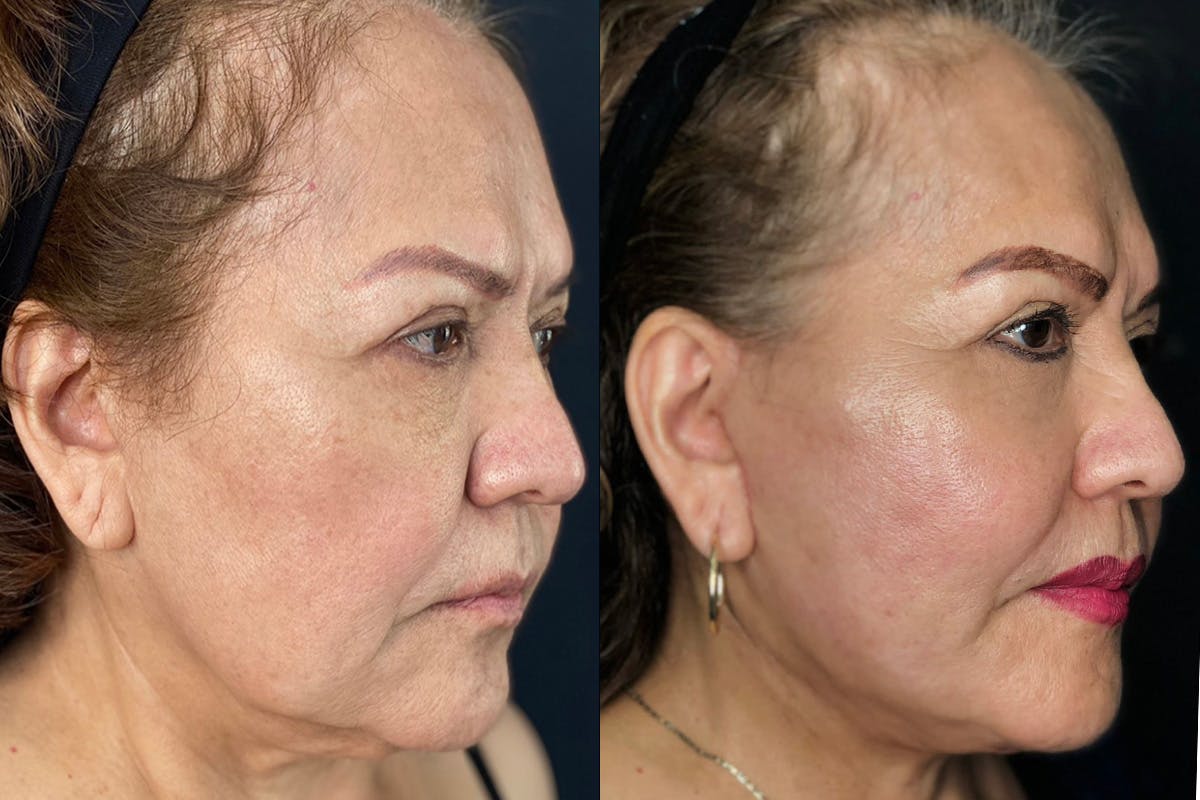 Facelift Before & After Gallery - Patient 56112234 - Image 1