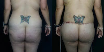 Liposuction Before & After Gallery - Patient 56112253 - Image 1