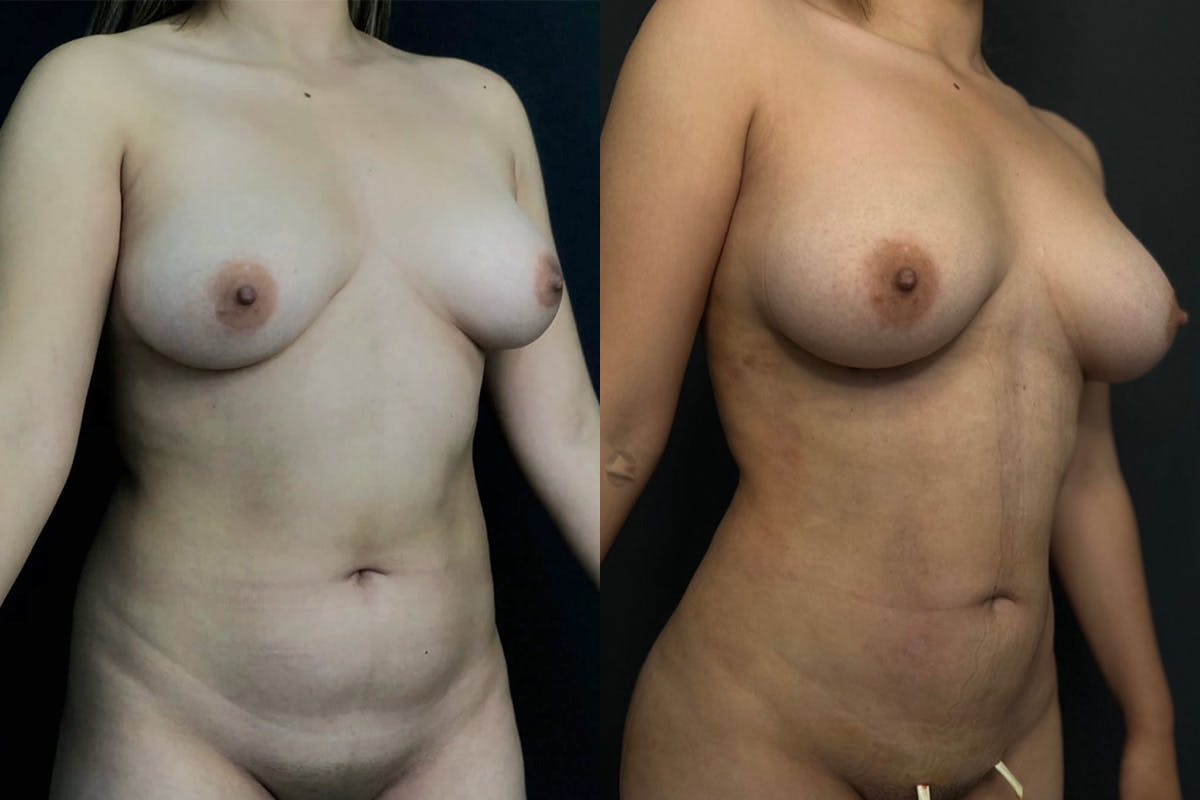 Liposuction Before & After Gallery - Patient 56112259 - Image 2