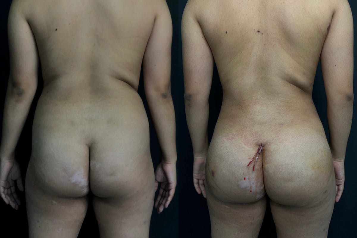 Brazilian Butt Lift Before & After Gallery - Patient 56112261 - Image 1