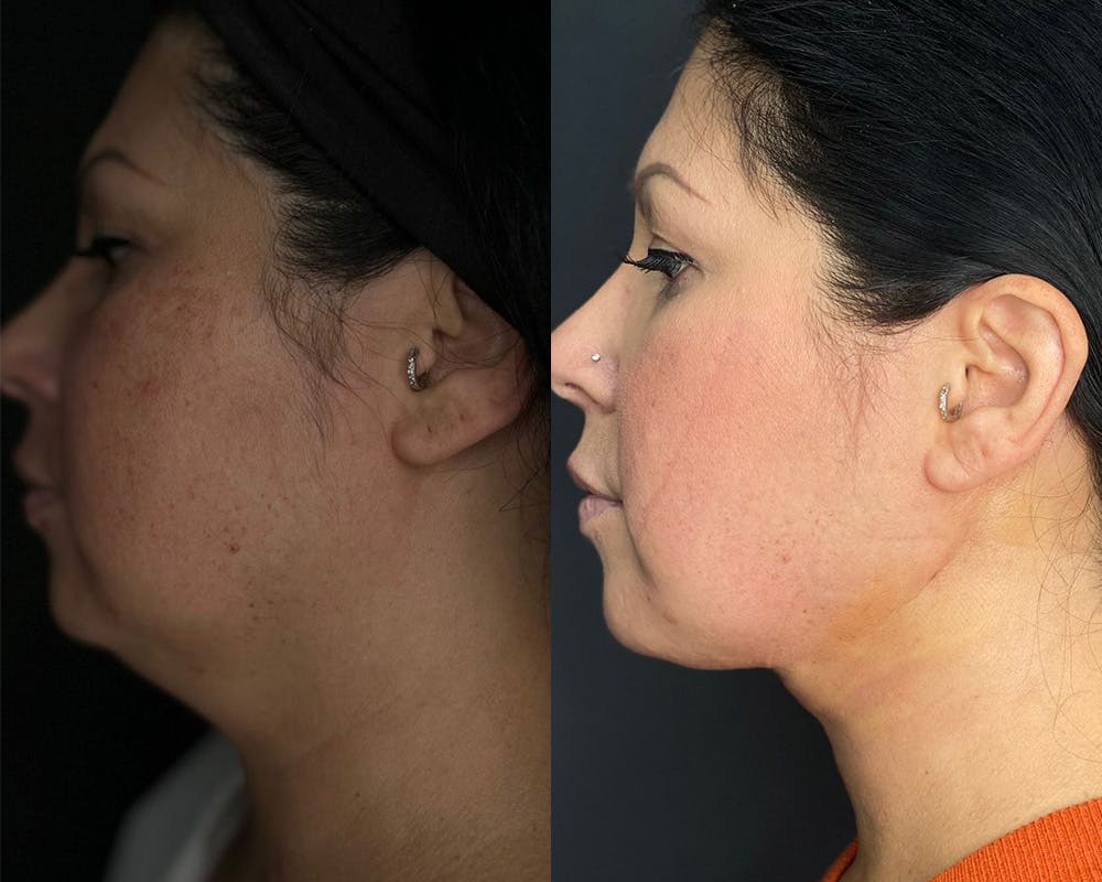 Neck Lift Before & After Gallery - Patient 56112315 - Image 1