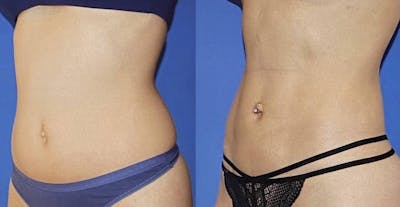 Tummy Tuck Before & After Gallery - Patient 63244650 - Image 1