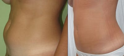 Tummy Tuck Before & After Gallery - Patient 63244653 - Image 1