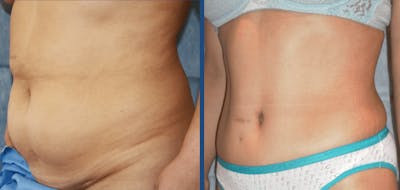Tummy Tuck Before & After Gallery - Patient 63244654 - Image 1