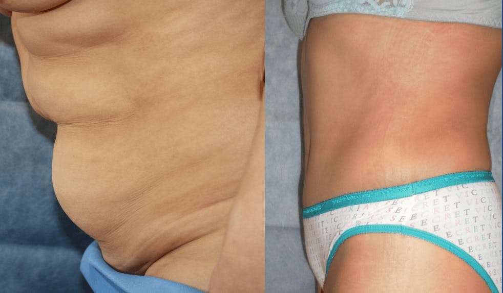 Tummy Tuck Before & After Gallery - Patient 63244655 - Image 1