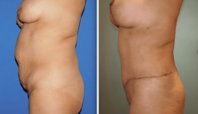 Tummy Tuck Before & After Gallery - Patient 63244656 - Image 1