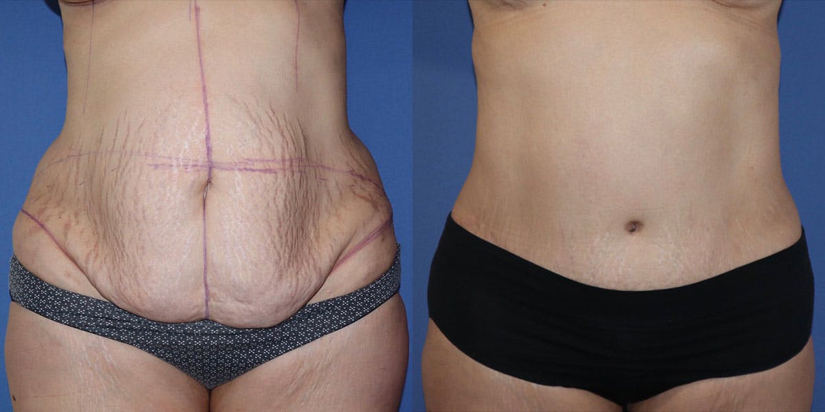 Tummy Tuck Before & After Gallery - Patient 63244657 - Image 1