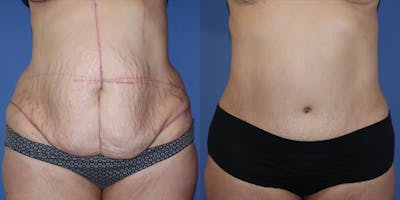 Tummy Tuck Before & After Gallery - Patient 63244657 - Image 1